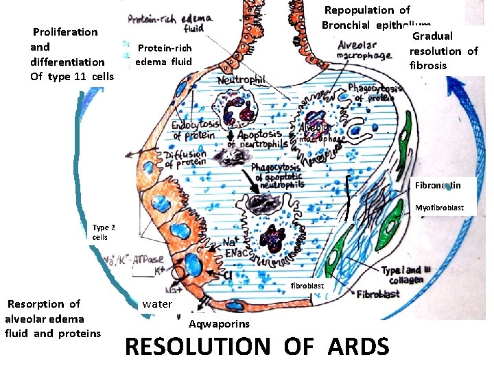 Proliferation and differentiation Of type 11 cells Protein-rich edema fluid Repopulation of Bronchial epithelium