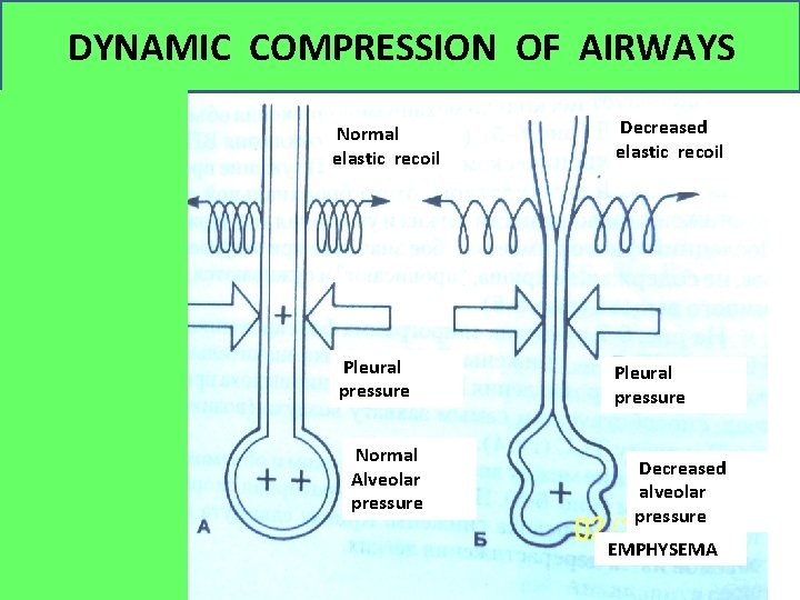 DYNAMIC COMPRESSION OF AIRWAYS Normal elastic recoil Pleural pressure Normal Alveolar pressure Decreased elastic