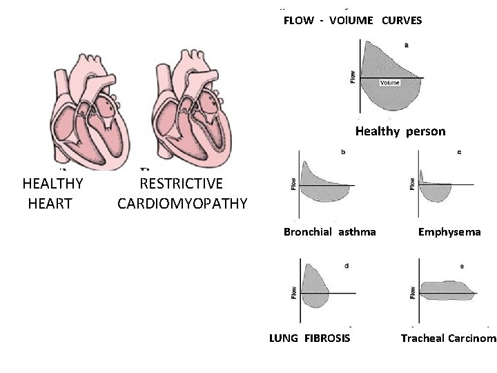 FLOW - VOl. UME CURVES Healthy person HEALTHY HEART RESTRICTIVE CARDIOMYOPATHY Bronchial asthma LUNG