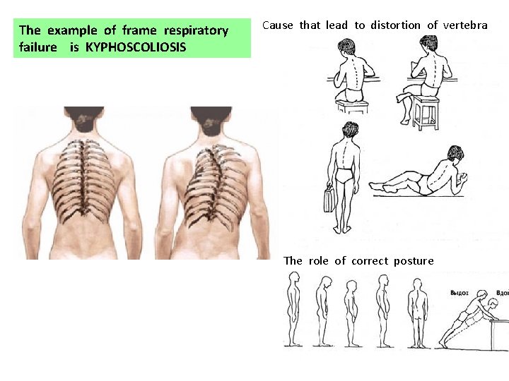 The example of frame respiratory failure is KYPHOSCOLIOSIS Cause that lead to distortion of