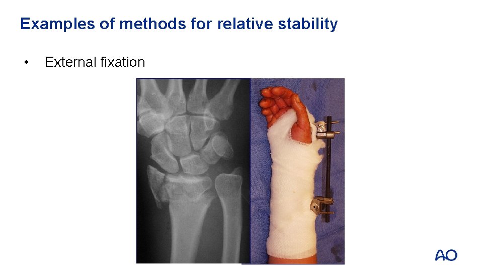 Examples of methods for relative stability • External fixation 