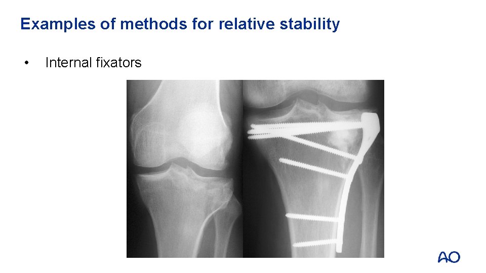 Examples of methods for relative stability • Internal fixators 