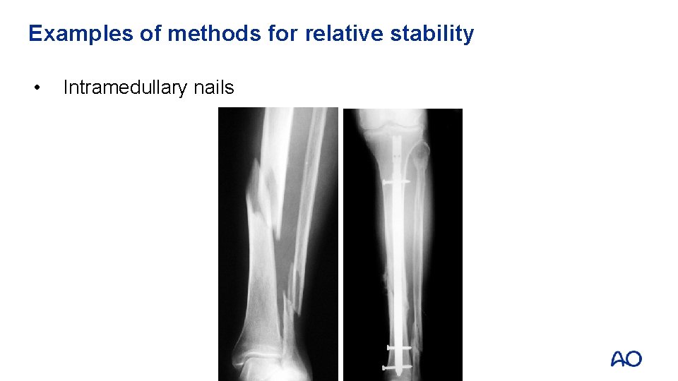 Examples of methods for relative stability • Intramedullary nails 