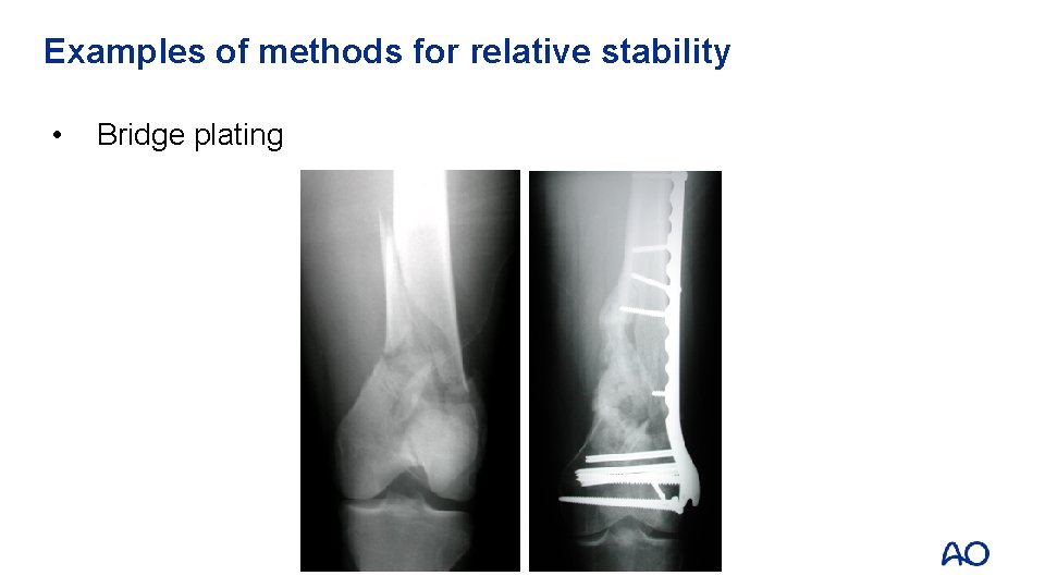 Examples of methods for relative stability • Bridge plating 