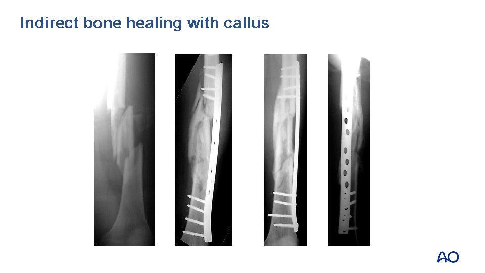 Indirect bone healing with callus 
