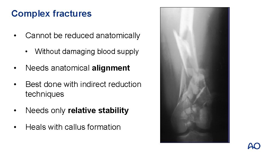 Complex fractures • Cannot be reduced anatomically • Without damaging blood supply • Needs