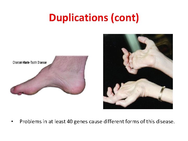 Duplications (cont) • Problems in at least 40 genes cause different forms of this