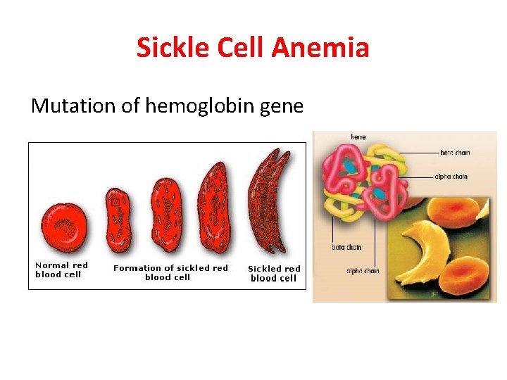 Sickle Cell Anemia Mutation of hemoglobin gene 