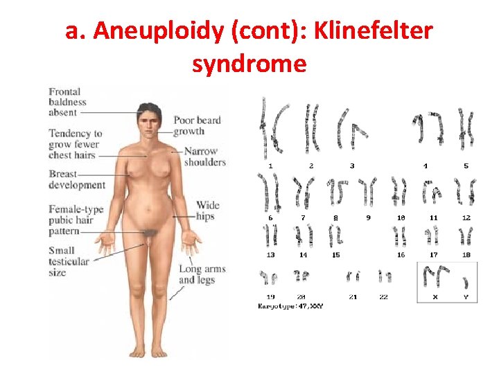 a. Aneuploidy (cont): Klinefelter syndrome 