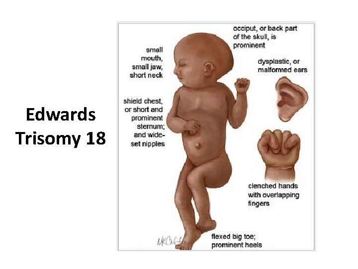 Edwards Trisomy 18 