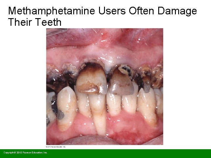 Methamphetamine Users Often Damage Their Teeth Copyright © 2010 Pearson Education, Inc. 