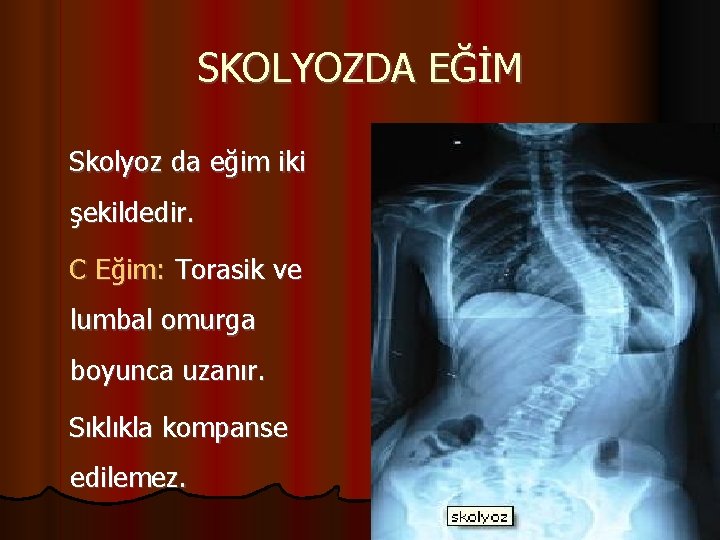 SKOLYOZDA EĞİM Skolyoz da eğim iki şekildedir. C Eğim: Torasik ve lumbal omurga boyunca