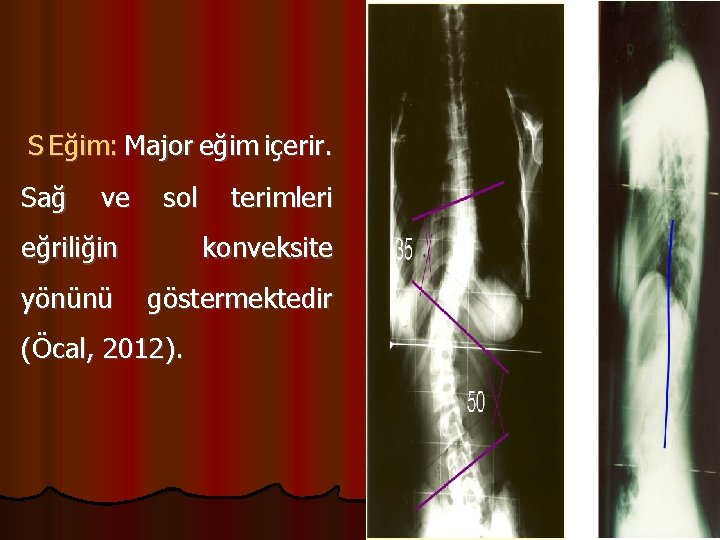 S Eğim: Major eğim içerir. Sağ ve sol terimleri eğriliğin konveksite yönünü göstermektedir (Öcal,