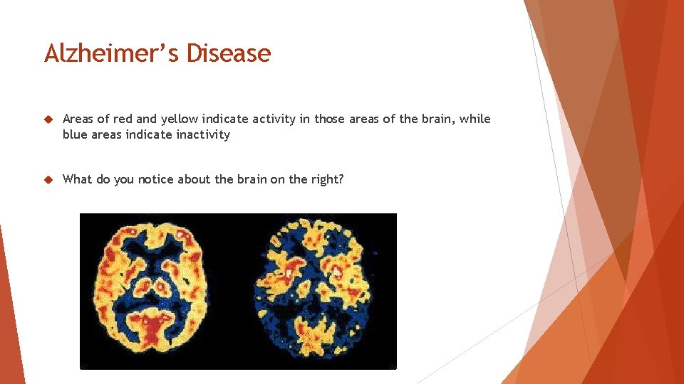 Alzheimer’s Disease Areas of red and yellow indicate activity in those areas of the