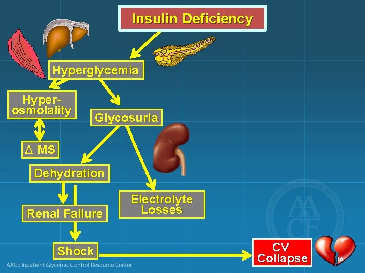 Insulin Deficiency Hyperglycemia Hyperosmolality Glycosuria Δ MS Dehydration Renal Failure Shock Electrolyte Losses CV