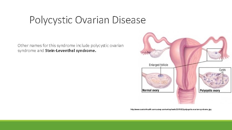 Polycystic Ovarian Disease Other names for this syndrome include polycystic ovarian syndrome and Stein-Leventhal