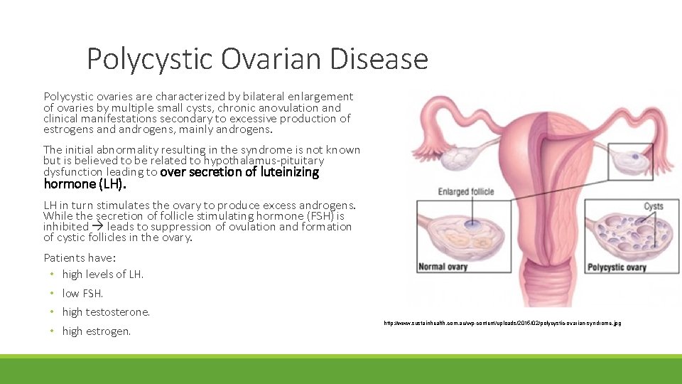 Polycystic Ovarian Disease Polycystic ovaries are characterized by bilateral enlargement of ovaries by multiple