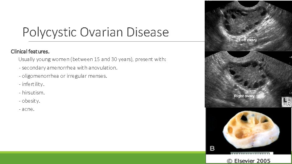 Polycystic Ovarian Disease Clinical features. Usually young women (between 15 and 30 years), present