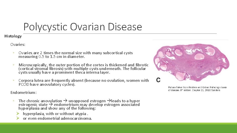 Histology Polycystic Ovarian Disease Ovaries: ◦ Ovaries are 2 times the normal size with
