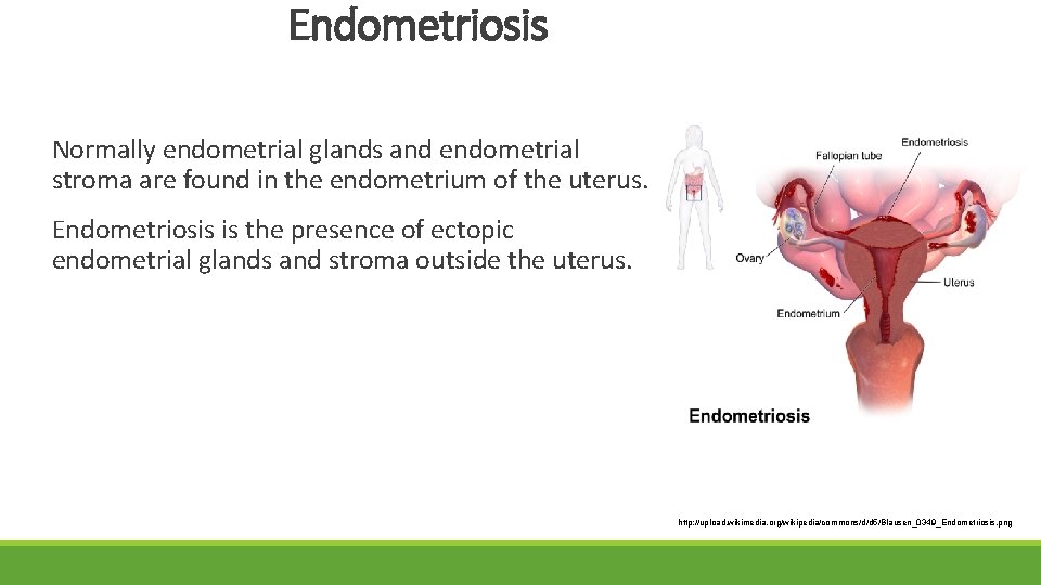 Endometriosis Normally endometrial glands and endometrial stroma are found in the endometrium of the