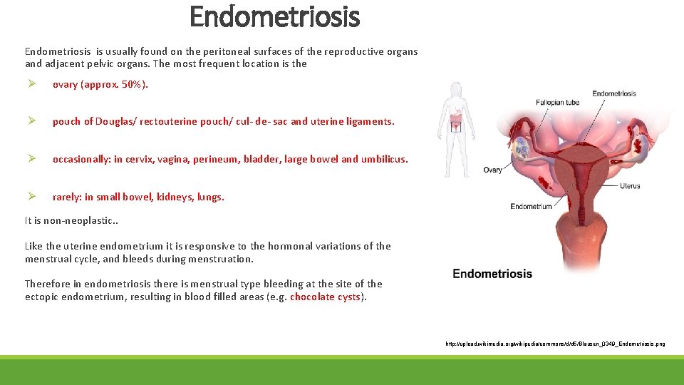 Endometriosis is usually found on the peritoneal surfaces of the reproductive organs and adjacent