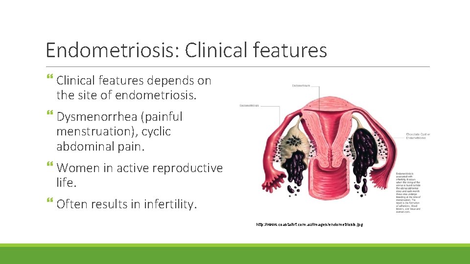 Endometriosis: Clinical features depends on the site of endometriosis. Dysmenorrhea (painful menstruation), cyclic abdominal