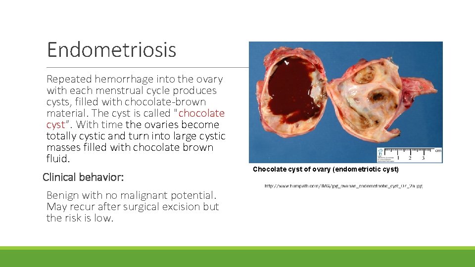 Endometriosis Repeated hemorrhage into the ovary with each menstrual cycle produces cysts, filled with