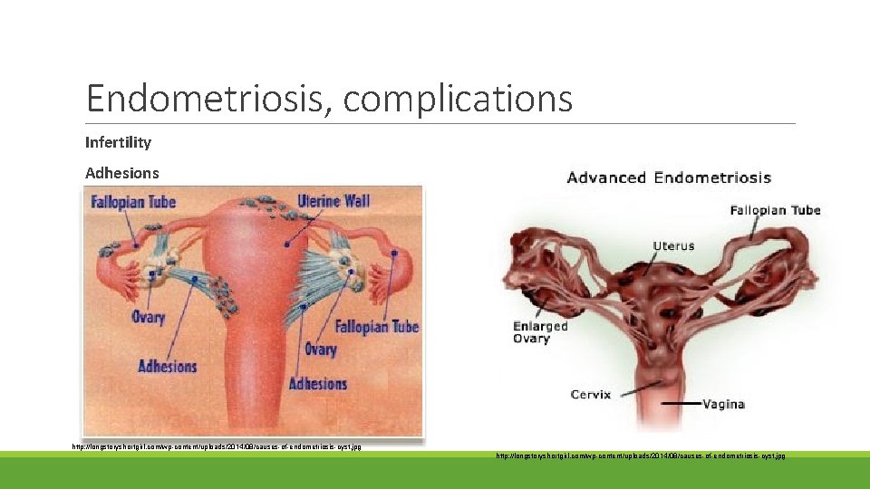 Endometriosis, complications Infertility Adhesions http: //longstoryshortgirl. com/wp-content/uploads/2014/08/causes-of-endometriosis-cyst. jpg 