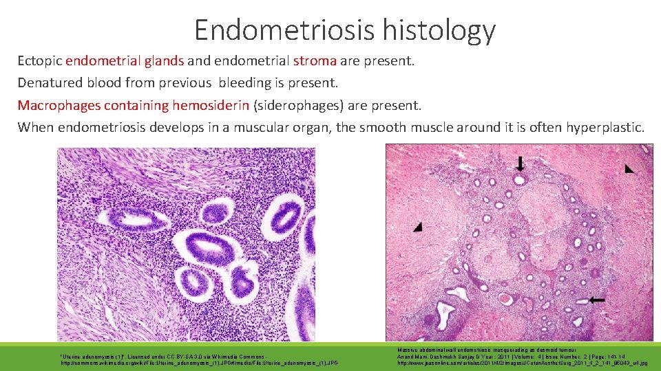 Endometriosis histology Ectopic endometrial glands and endometrial stroma are present. Denatured blood from previous