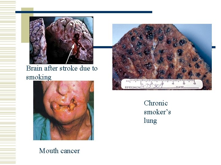 Brain after stroke due to smoking Chronic smoker’s lung Mouth cancer 