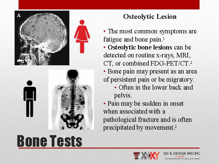 A Osteolytic Lesion • The most common symptoms are fatigue and bone pain. 1