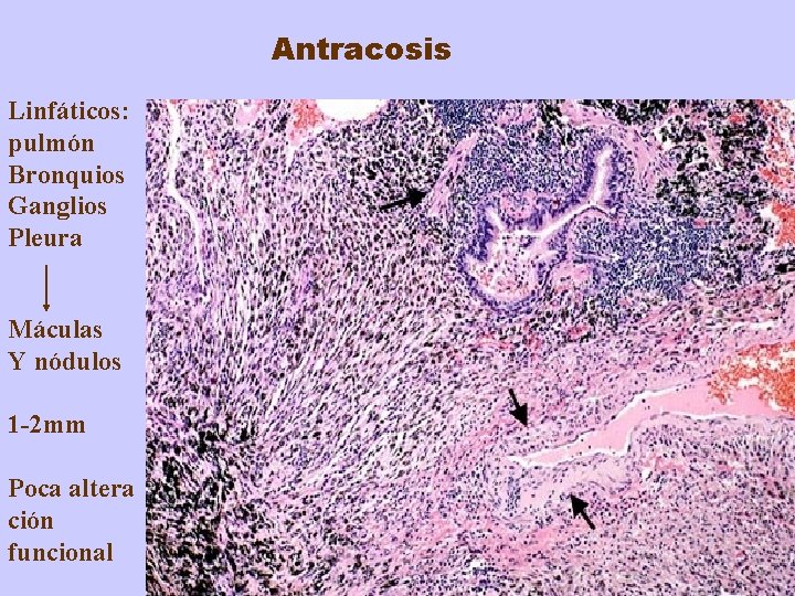 Antracosis Linfáticos: pulmón Bronquios Ganglios Pleura Máculas Y nódulos 1 -2 mm Poca altera