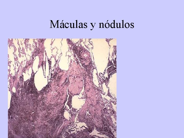 Máculas y nódulos 