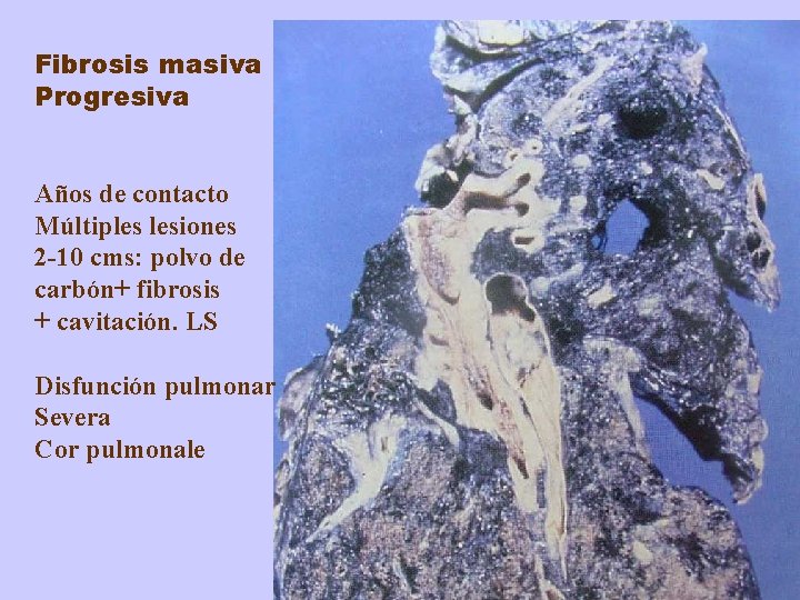 Fibrosis masiva Progresiva Años de contacto Múltiples lesiones 2 -10 cms: polvo de carbón+