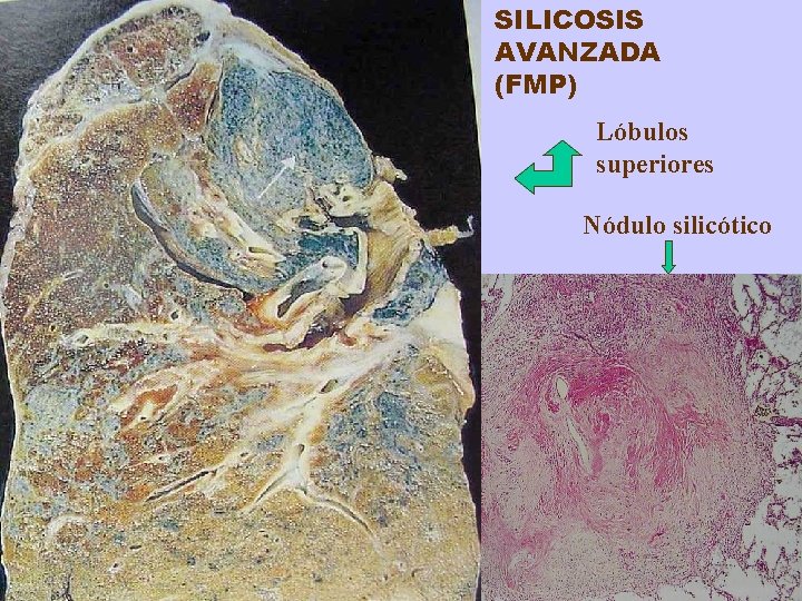 SILICOSIS AVANZADA (FMP) Lóbulos superiores Nódulo silicótico 