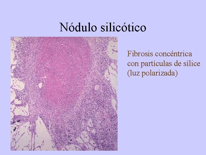 Nódulo silicótico Fibrosis concéntrica con partículas de sílice (luz polarizada) 