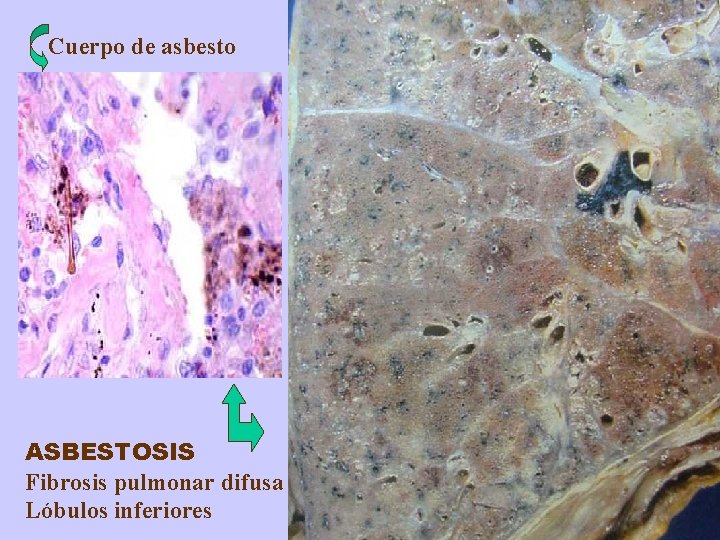 Cuerpo de asbesto ASBESTOSIS Fibrosis pulmonar difusa Lóbulos inferiores 
