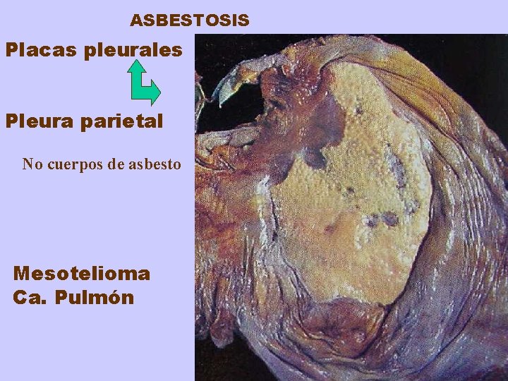 ASBESTOSIS Placas pleurales Pleura parietal No cuerpos de asbesto Mesotelioma Ca. Pulmón 