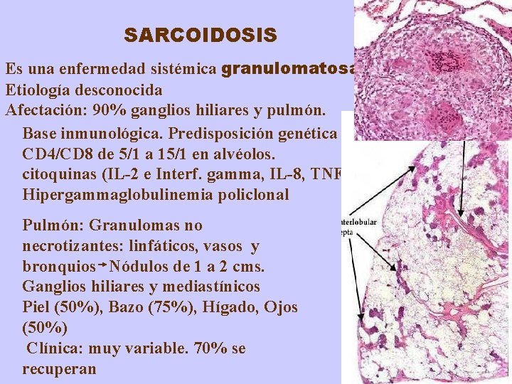 SARCOIDOSIS Es una enfermedad sistémica granulomatosa Etiología desconocida Afectación: 90% ganglios hiliares y pulmón.
