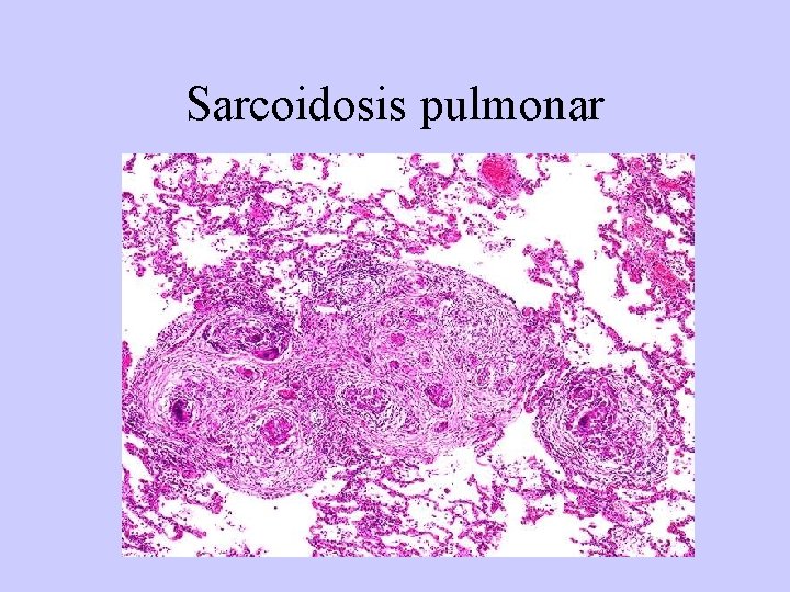Sarcoidosis pulmonar 
