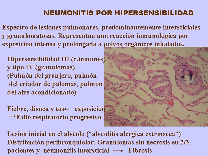 NEUMONITIS POR HIPERSENSIBILIDAD Espectro de lesiones pulmonares, predominantemente intersticiales y granulomatosas. Representan una reacción