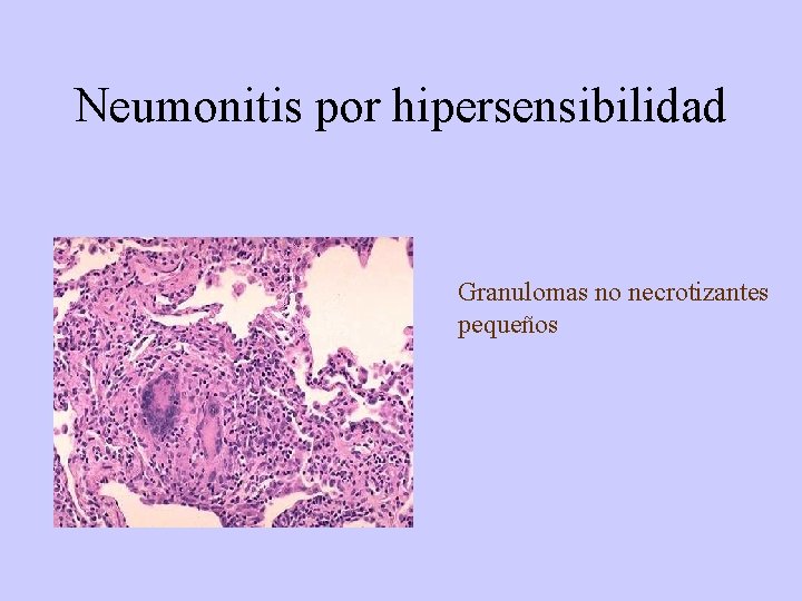 Neumonitis por hipersensibilidad Granulomas no necrotizantes pequeños 