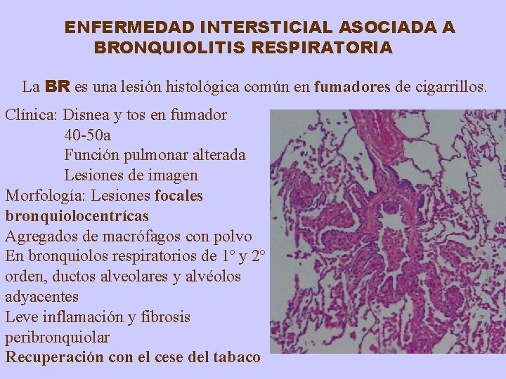 ENFERMEDAD INTERSTICIAL ASOCIADA A BRONQUIOLITIS RESPIRATORIA La BR es una lesión histológica común en