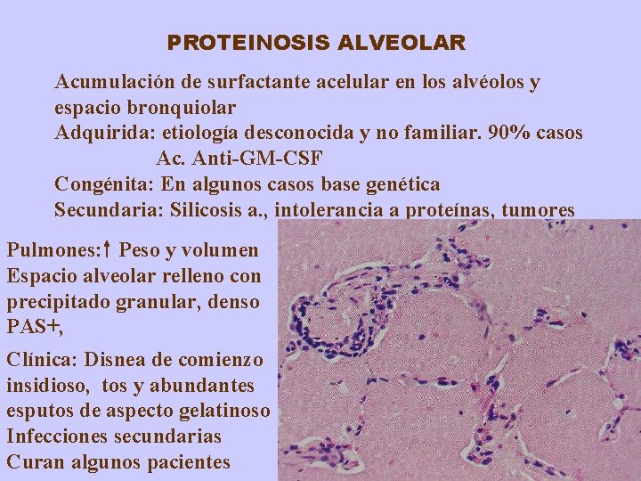 PROTEINOSIS ALVEOLAR Acumulación de surfactante acelular en los alvéolos y espacio bronquiolar Adquirida: etiología