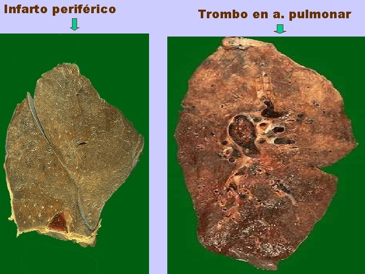 Infarto periférico Trombo en a. pulmonar 