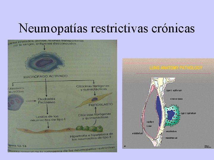 Neumopatías restrictivas crónicas 
