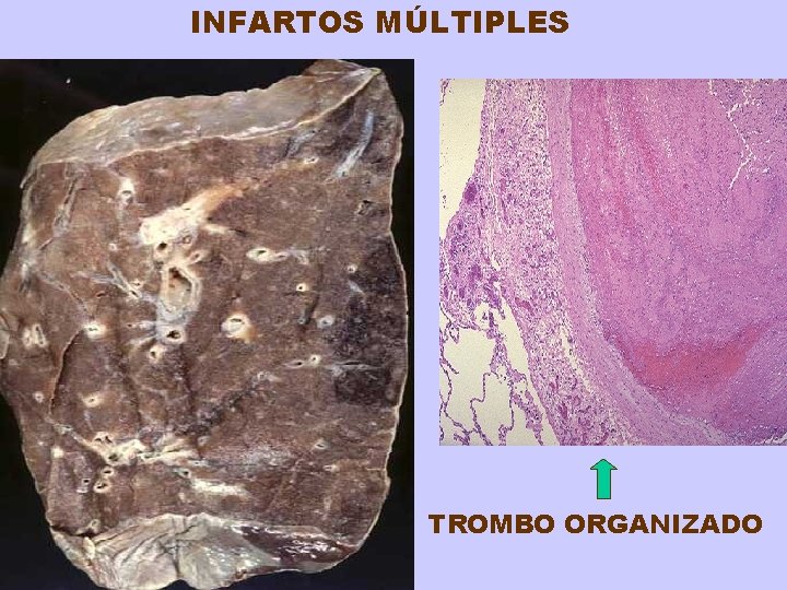INFARTOS MÚLTIPLES TROMBO ORGANIZADO 