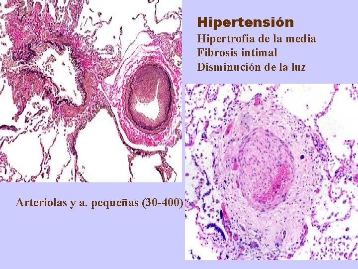 Hipertensión Hipertrofia de la media Fibrosis intimal Disminución de la luz Arteriolas y a.
