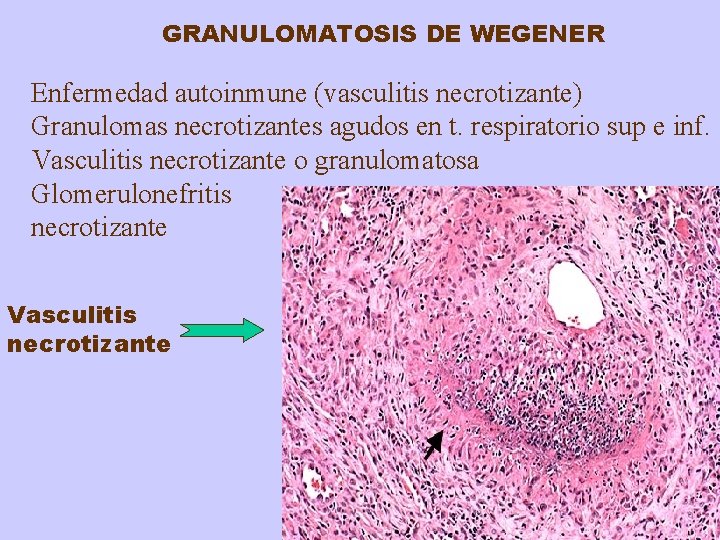 GRANULOMATOSIS DE WEGENER Enfermedad autoinmune (vasculitis necrotizante) Granulomas necrotizantes agudos en t. respiratorio sup
