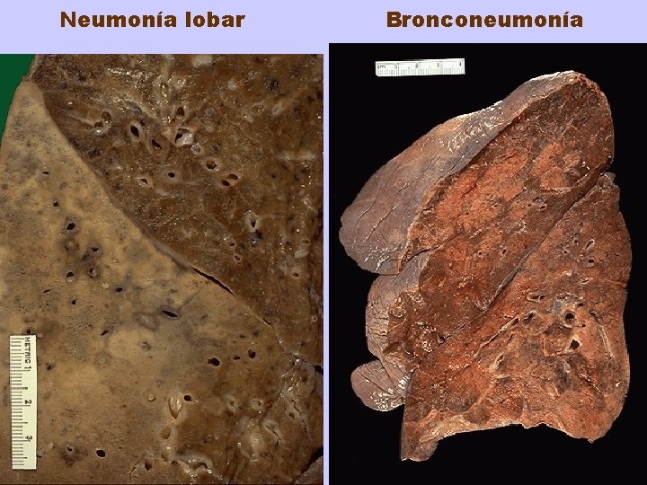 Neumonía lobar Bronconeumonía 